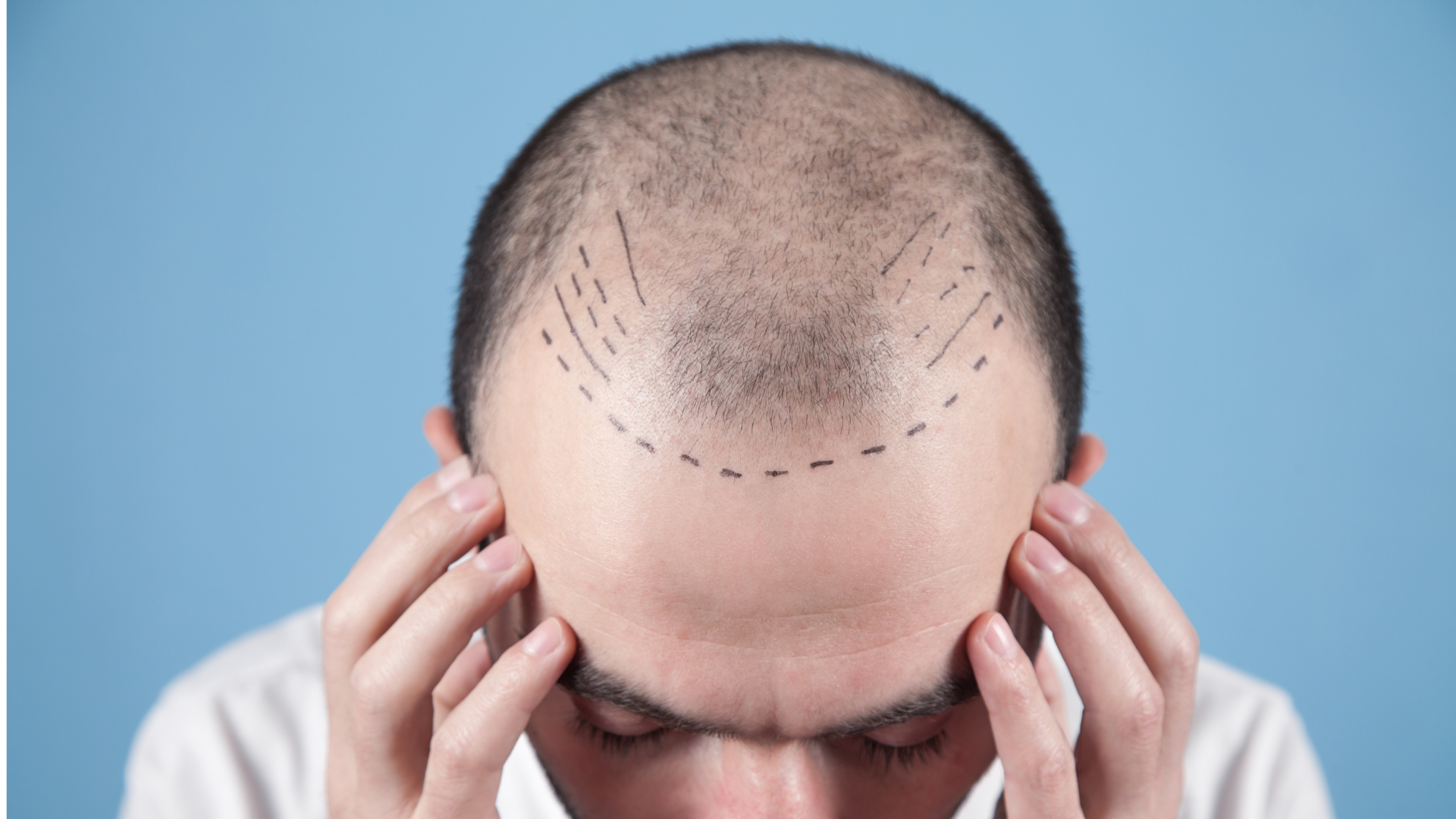 Hair Transplant