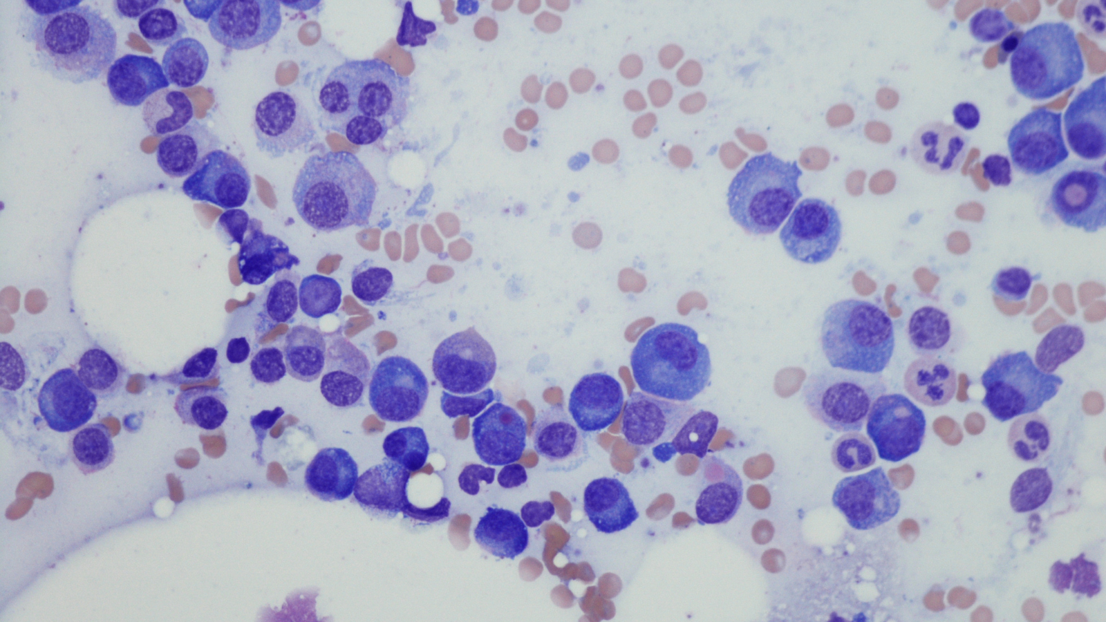 Bone marrow aspiration