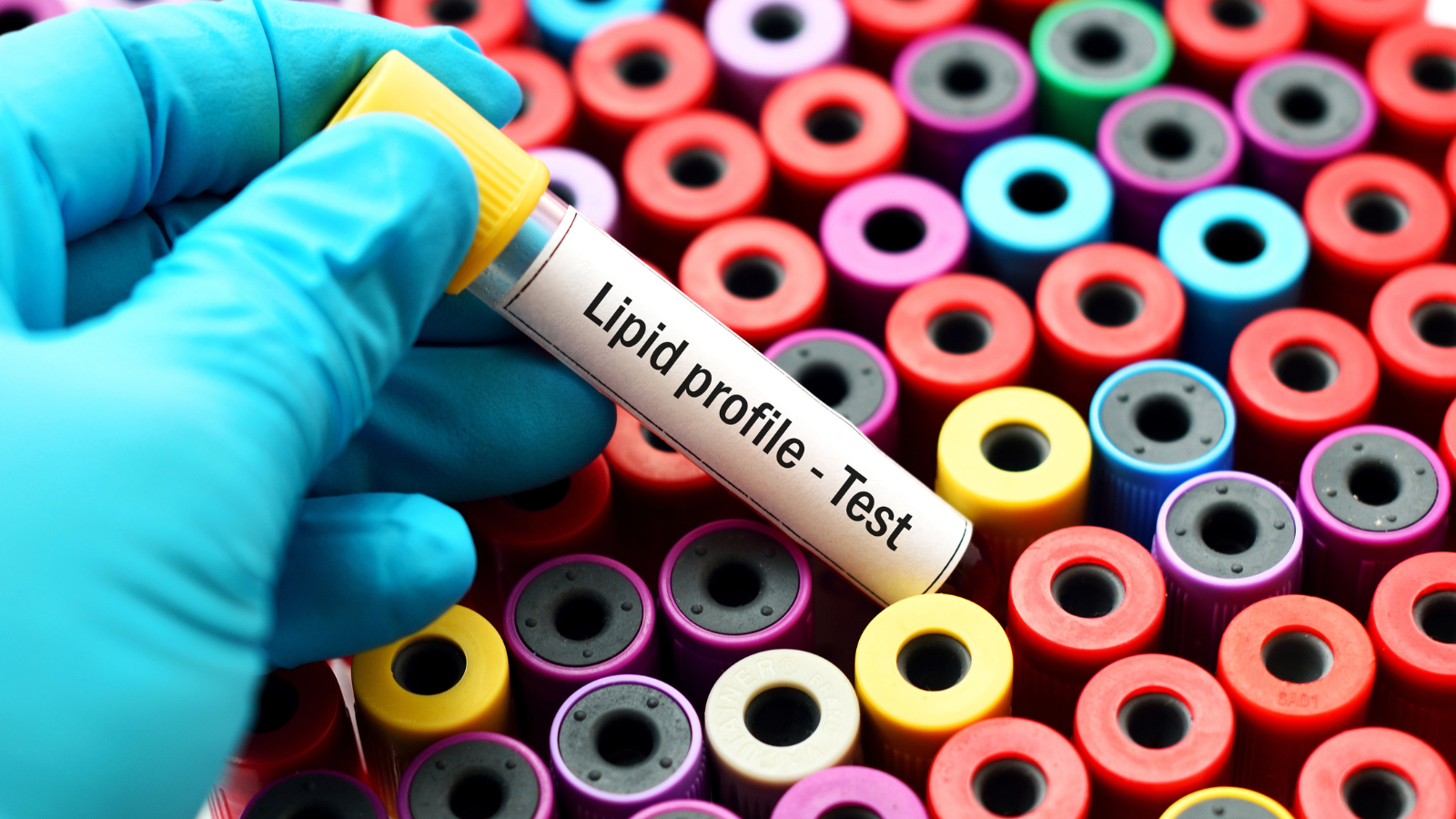 Lipid profile